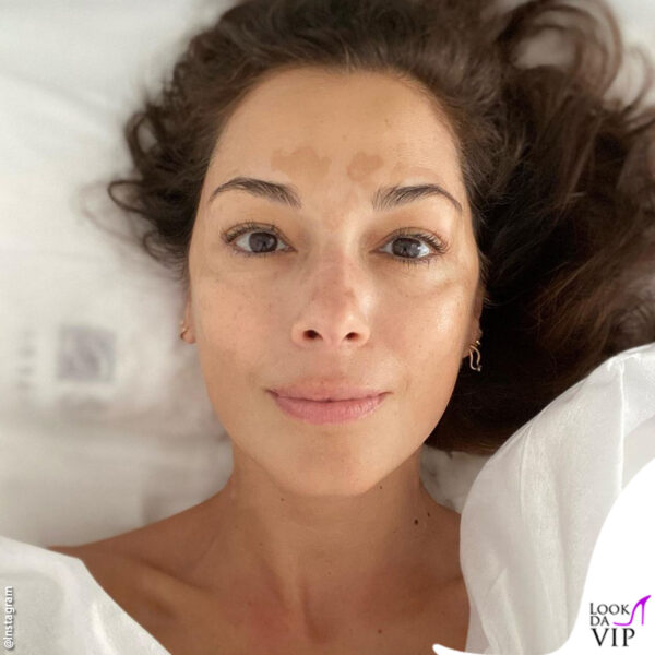 Giorgia Surina macchie sulla pelle: vitiligine?