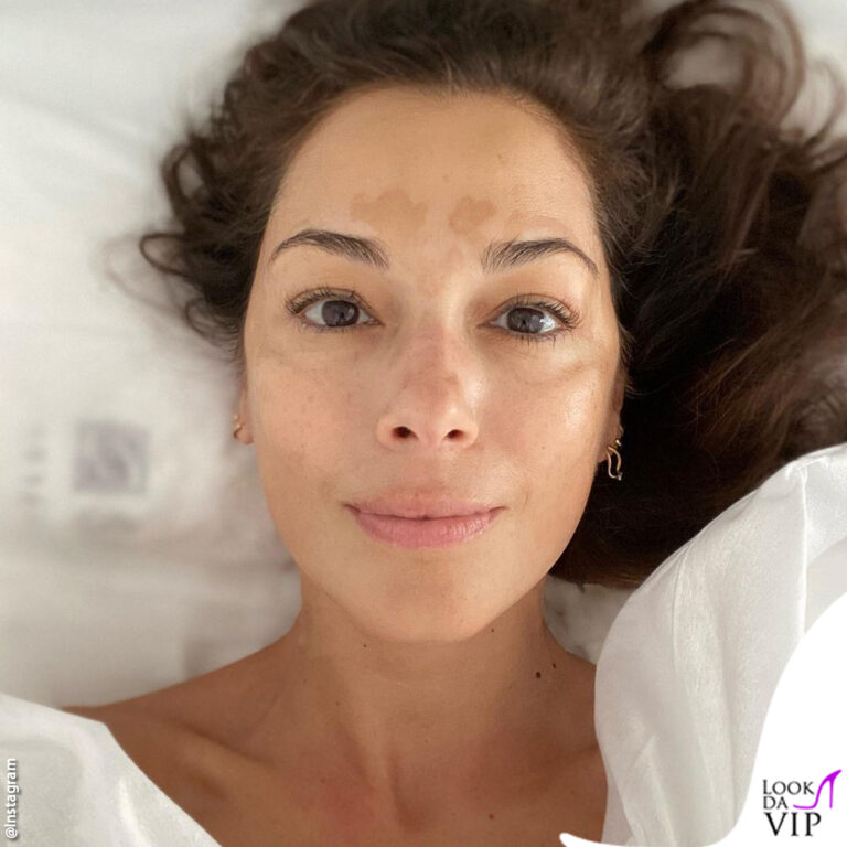 Giorgia Surina macchie sulla pelle: vitiligine?