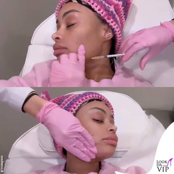 Angela rimuove i filler in volto 